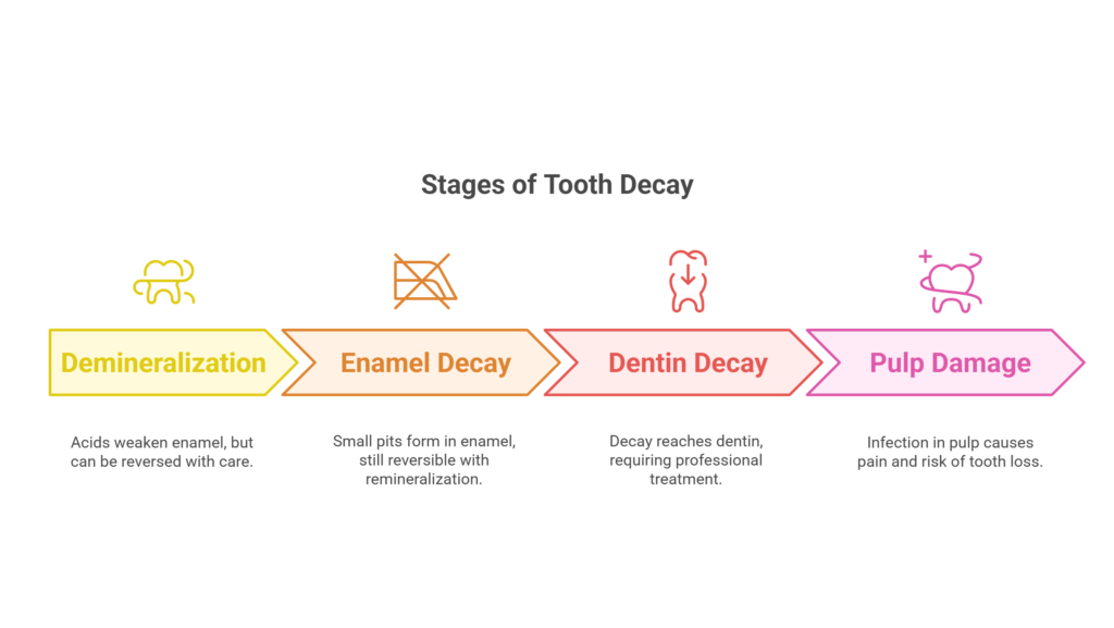 Understanding the Stages of Tooth Decay