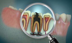 How to Stop Tooth Decay Before It Starts
