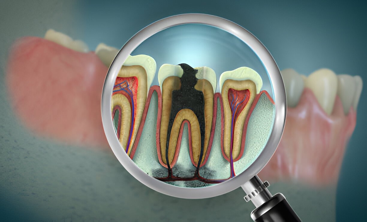How to Stop Tooth Decay Before It Starts