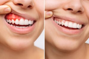 Natural Gum Reversal Solution