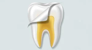 An illustration showing the white enamel layer of a tooth peeling back to reveal the yellow dentin underneath, symbolizing a primary cause of yellow teeth.