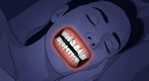 An illustration depicting a person sleeping peacefully with a serene expression, while inside their mouth, their teeth are shown grinding and cracking, symbolizing the silent damage of bruxism.